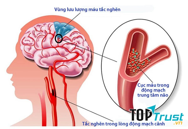 Một nửa số người bị tai biến mạch máu não đều tử vong