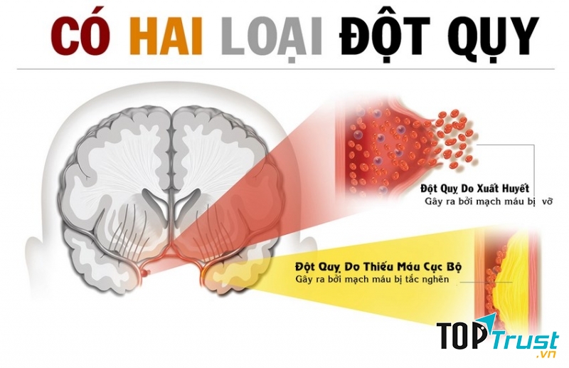 Tai biến mạch máu não (đột quỵ)