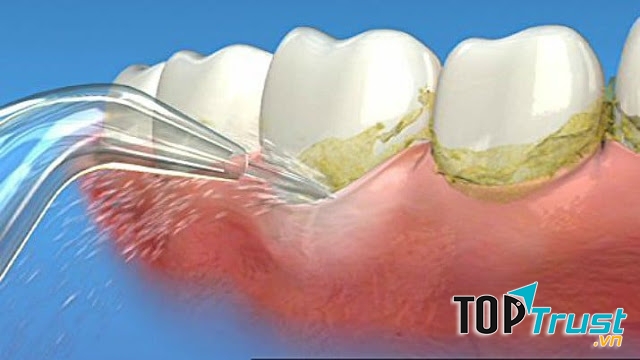 Tăm nước Water Pik Plus WP-450 có nhiều đầu và vòi vệ sinh răng miệng giúp làm sạch hiệu quả, nhanh chóng.