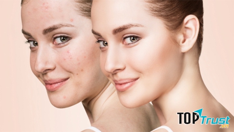 Thạc sĩ, Bác sĩ chuyên khoa II Đặng Thị Tốn bác sĩ có tiếng trong việc điều trị mụn