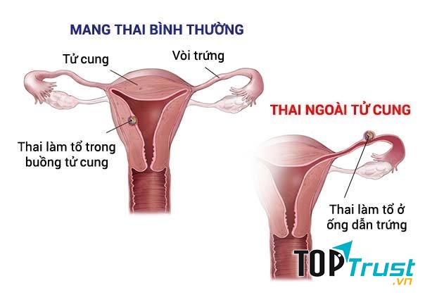 Thai ngoài tử cung có thể đe dọa tính mạng của người mẹ
