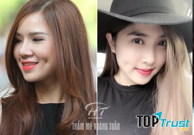 Khách hàng tạo má lúm tại TMV Hoàng Tuấn