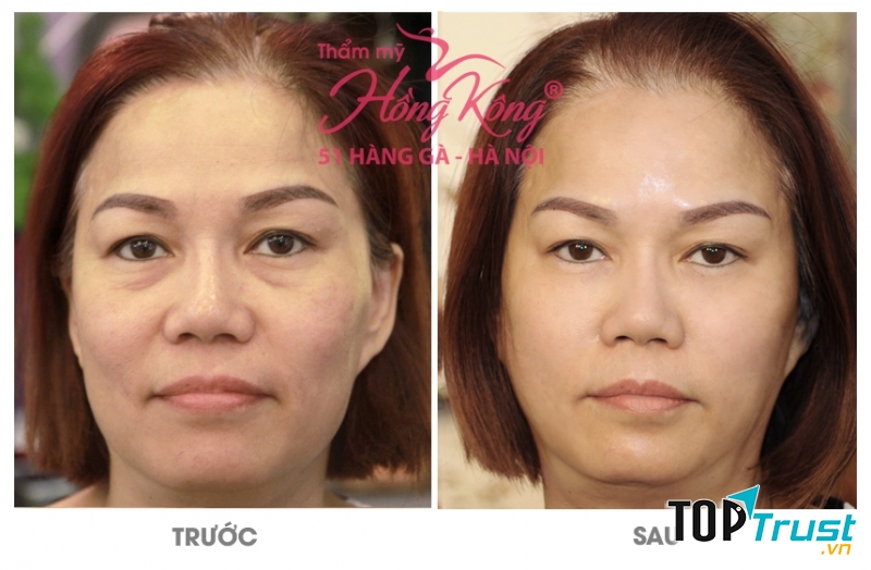 Khách hàng của TM Hồng Kông trước và sau xóa nhăn