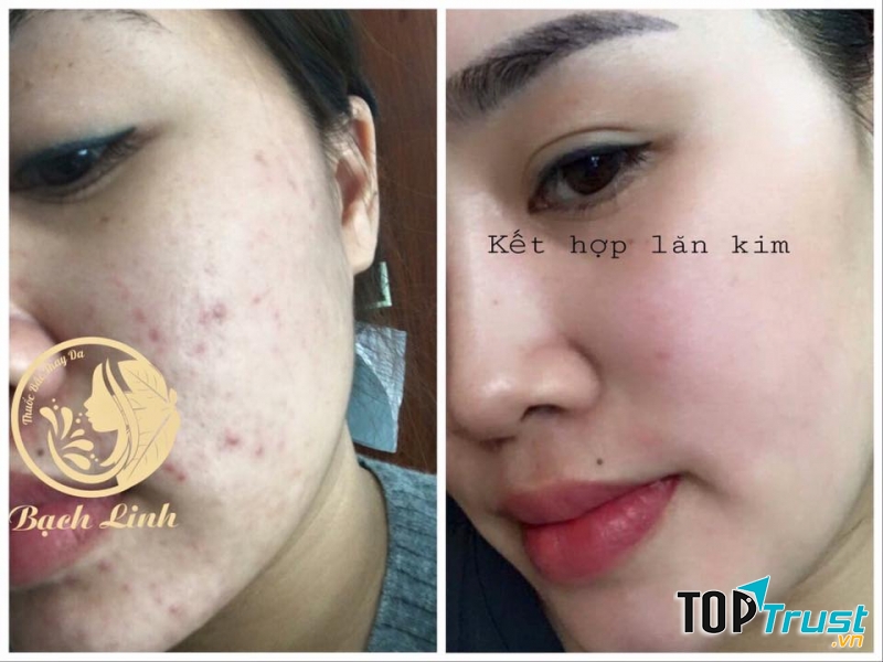 Rất nhiều ca mụn nặng đã được Thẩm mỹ Hường Hoàng chữa khỏi