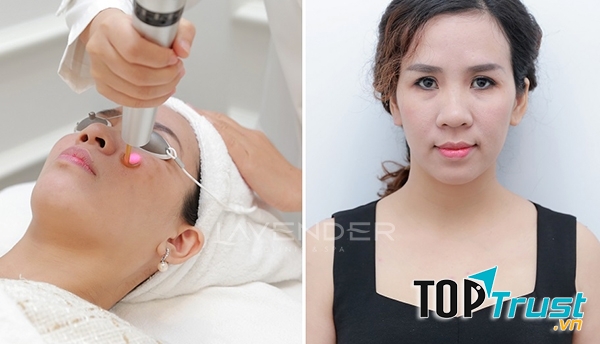 Sự thay đổi rõ rệt khi điều trị tàn nhang tại Laveder