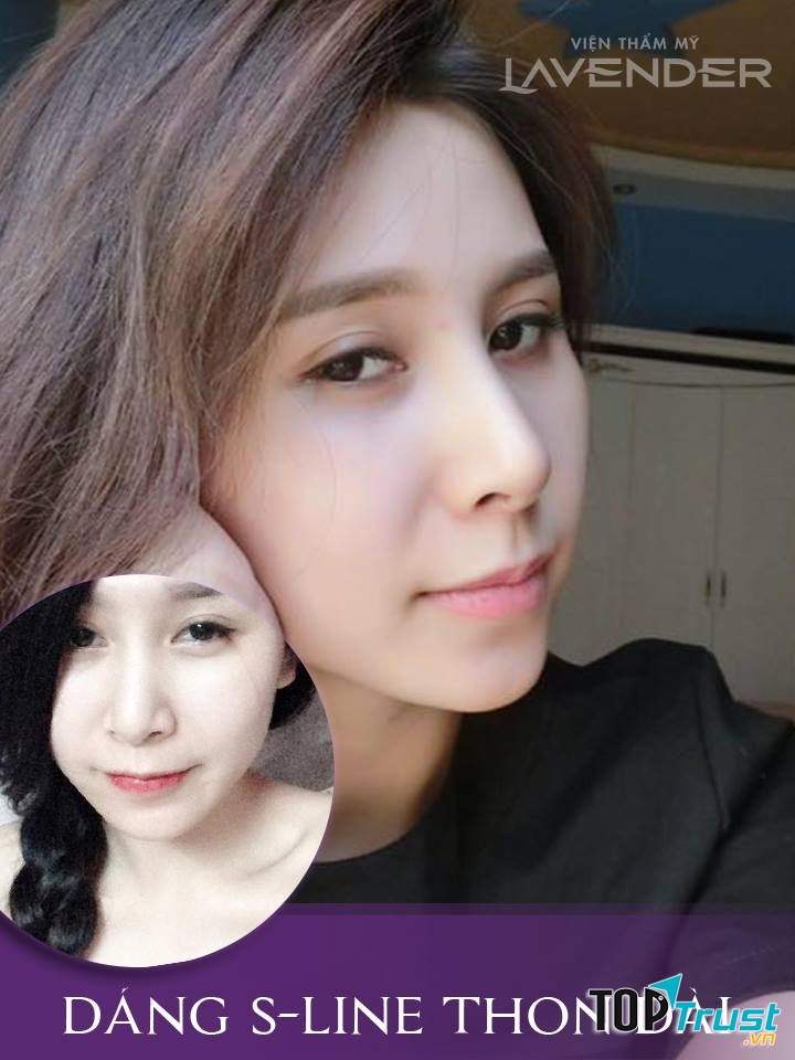 Khách hàng sử dụng dịch vụ nâng mũi S-line tại Lavender