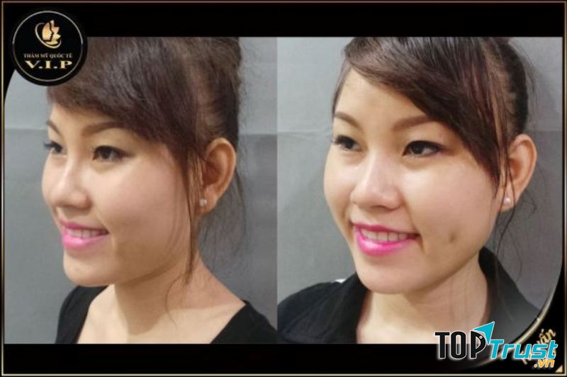 Má lúm hoàn hảo được tạo ra bởi đội ngũ bác sĩ giỏi tại TMV V.I.P