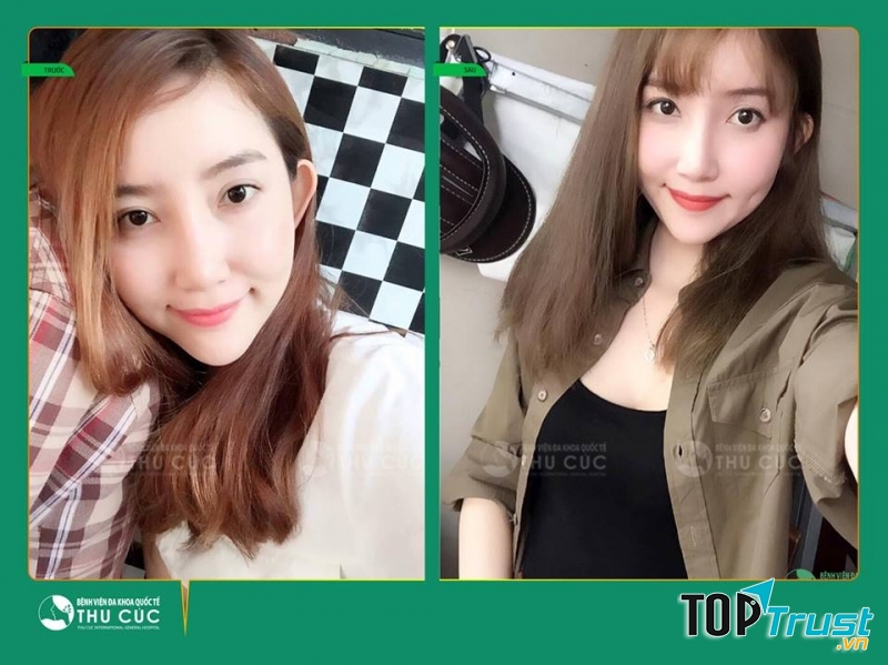 Khách hàng sử dụng dịch vụ tại thẩm mỹ Thu Cúc