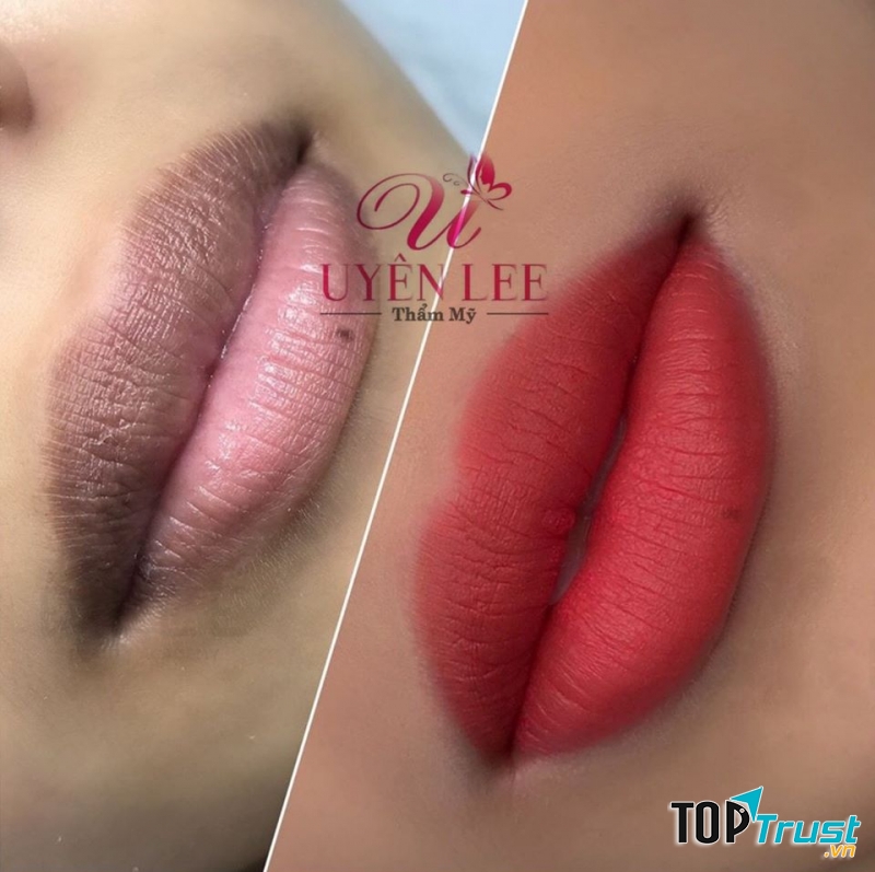 Thẩm mỹ Uyên Lee