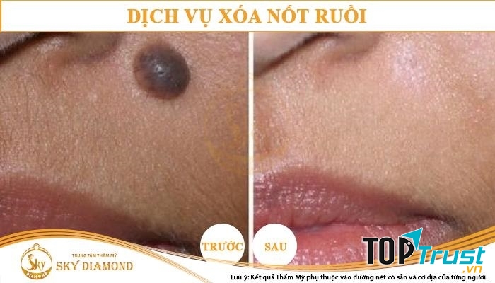 Sky Diamond - địa chỉ tẩy nốt ruồi hiệu quả và uy tín