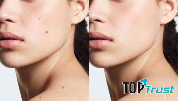 Đến TMV Thành Thủy bạn sẽ thấy nốt ruồi kém duyên biến mất không còn dấu vết