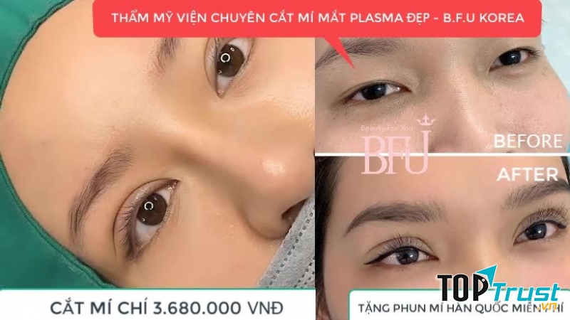 Cắt mí Plasma tại  Thẩm mỹ viện BFU Korea