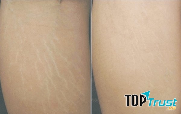 Kết quả sau điều trị rạn da tại TMV châu Á Sài Gòn