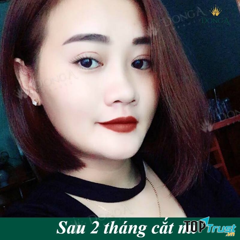 Thẩm Mỹ Viện Đông Á - địa chỉ nhấn mí mắt đẹp và an toàn nhất ở TP. HCM