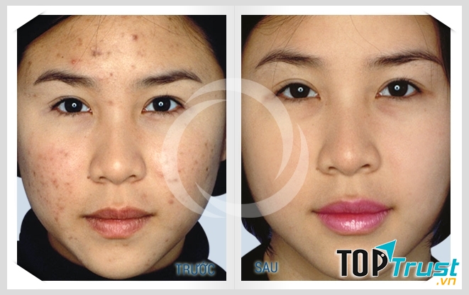 Khách hàng thay đổi hẳn sau khi trị mụn