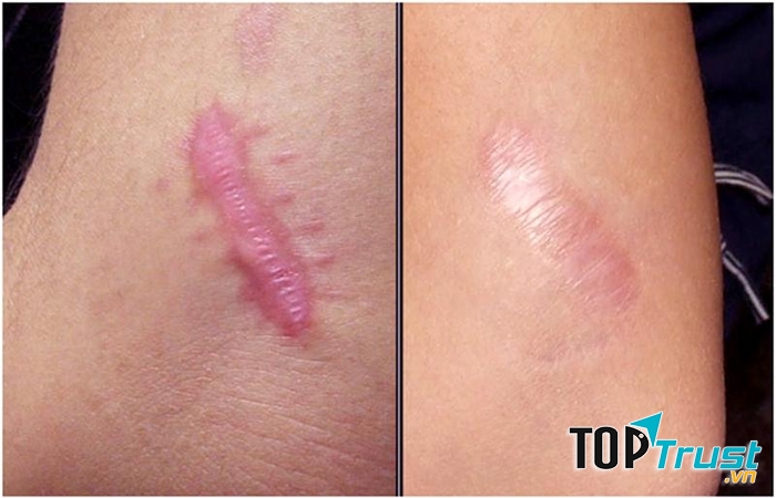 Kết quả trước và sau điều trị tại Đông Á