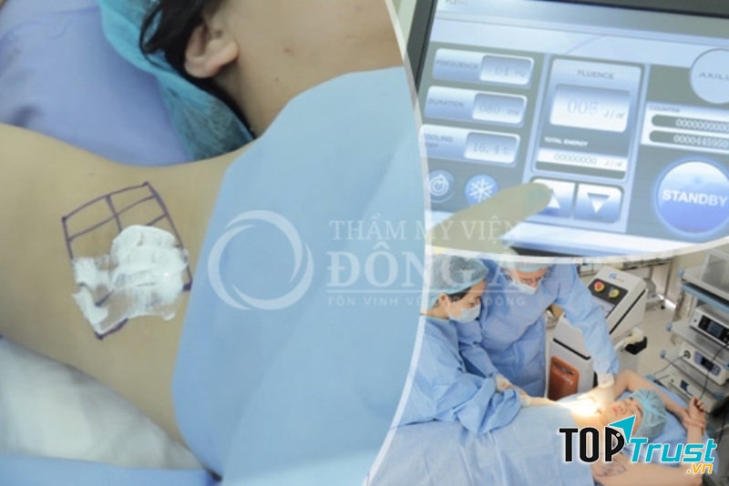 Ultra Dry không gây đau, không bỏng rát