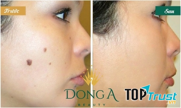 Kết quả sau khi tẩy bằng laser siêu xung của khách hàng