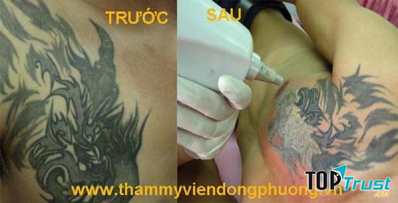 Xóa hình xăm bằng công nghệ LASER ND-YAG