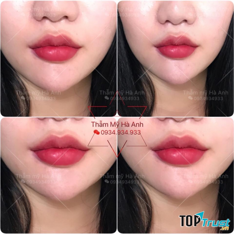 Thẩm Mỹ Viện Hà Anh