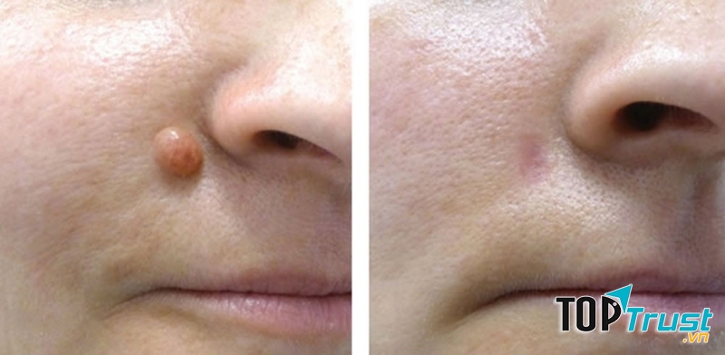 Nốt ruồi hoàn toàn biến mất sau điều trị tại TMV Hân Hân