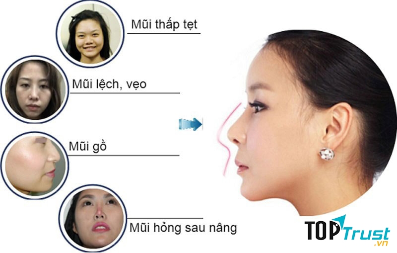 Tạo nên dáng mũi Sline, Lline như khách hàng mong muốn.