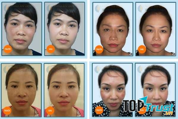 Sự thay đổi của khách hàng trước và sau trị nám