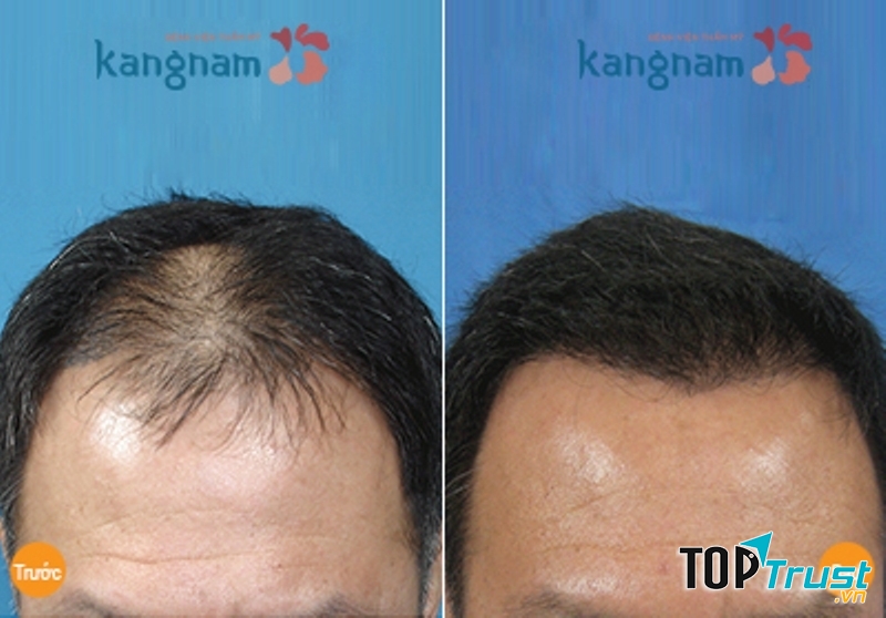 Tóc mọc dày và đều sau điều trị tại Kangnam