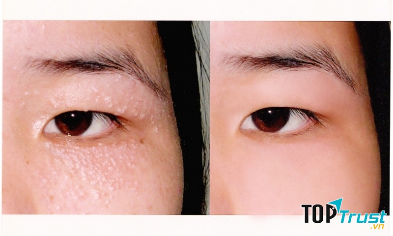 Thẩm mỹ viện Kangnam Hà Nội - Spa trị mụn tốt nhất tại Hà Nội