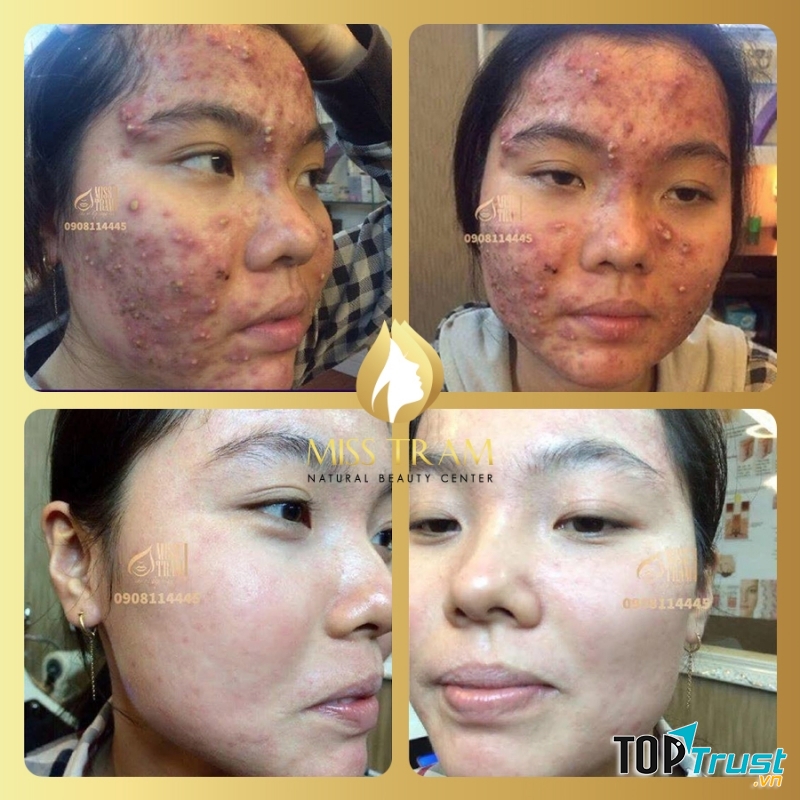 Ca trị mụn tại Miss Trâm