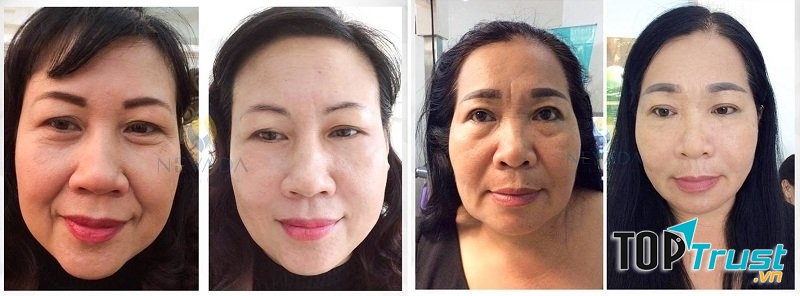 Khách hàng trước và sau liệu trình xóa nhăn tại TMV Nevada