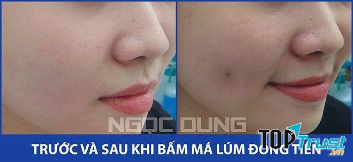 Khách hàng tạo má lúm đẹp tại TMV Ngọc Dung