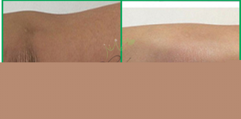 Trước và sau khi trị thâm khuỷu tay hiệu quả tại Reborn Clinic.