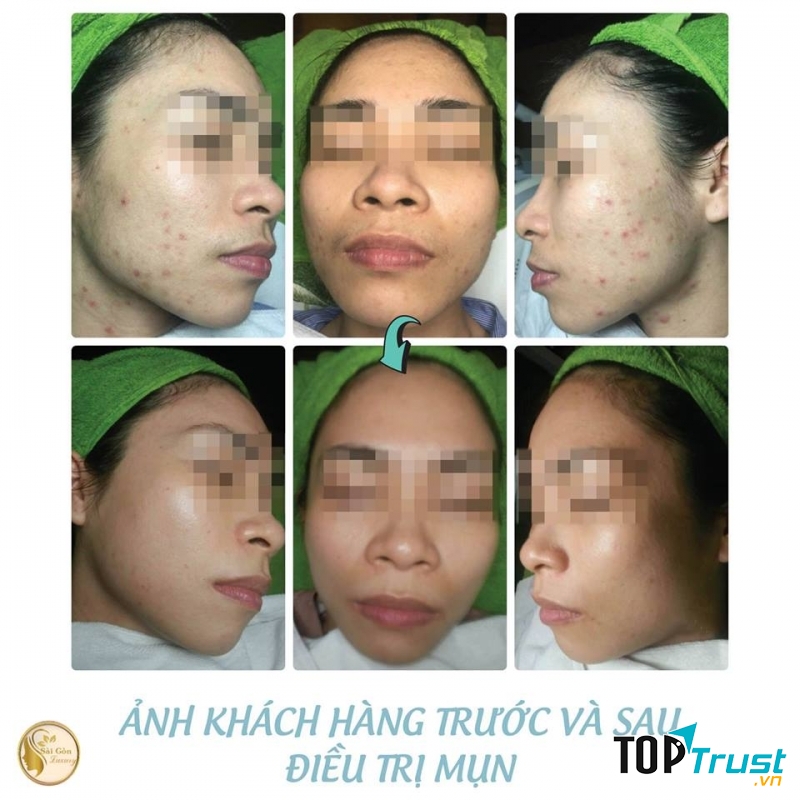 Hầu hết da của các khách hàng đến với Thẩm mỹ viện Sài Gòn Luxury Hải Dương đều được cải thiện đáng kể sau một liệu trình