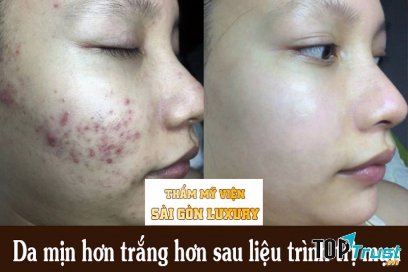 Thẩm mỹ viện Sài Gòn Luxury Hải Dương là địa chỉ rất đáng tin cậy cho các chị em.