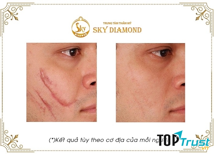 Kết quả sau khi trị sẹo tại TMV Sky Diamond