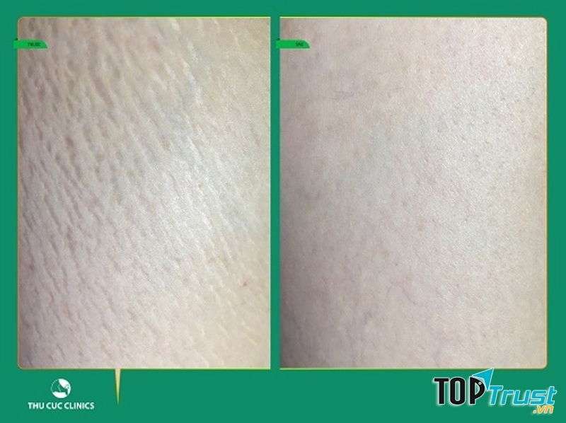 Kết quả trước và sau điều trị rạn da tại Thu Cúc