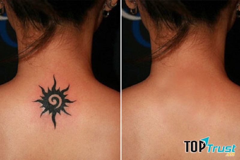 Xóa hình xăm bằng công nghệ laser Yag