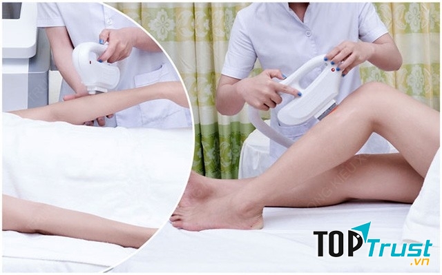 Công nghệ triệt lông tại mỹ viện Kiều Xuân, an toàn hiệu quả