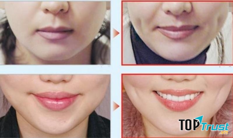 Khách hàng tạo má lúm tại TMV Văn Trường