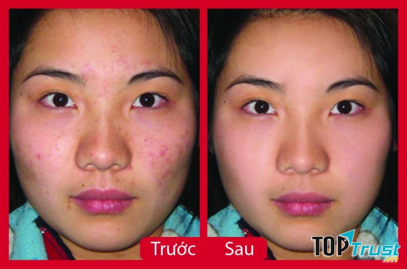 Thẩm mỹ viện Xuân Hương - Spa trị mụn tốt nhất tại Hà Nội