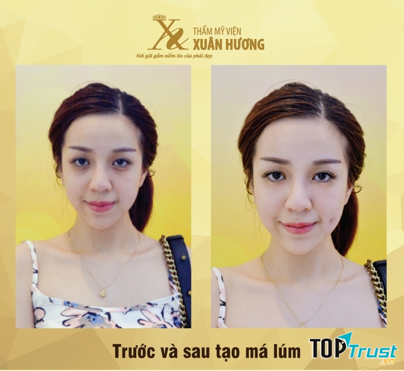 Khách hàng trước và sau tạo má lúm tại TMV Xuân Hương