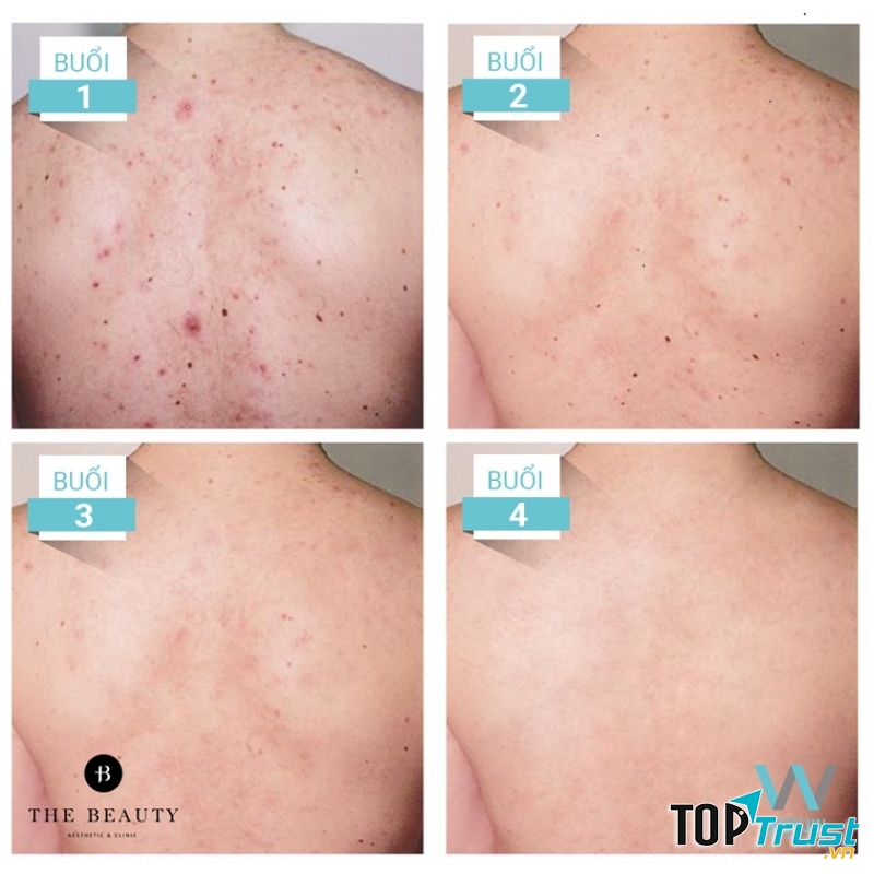 Liệu trình trị mụn lưng body smooth cũng là một liệu trình được rất nhiều bạn trẻ quan tâm trong hè này.