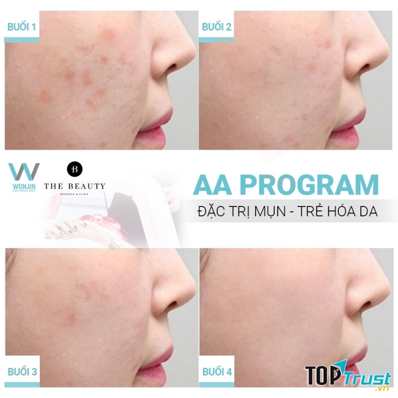 Kết quả của liệu trình đặc trị mụn - trẻ hóa da trên khách hàng của The Beauty Clinic