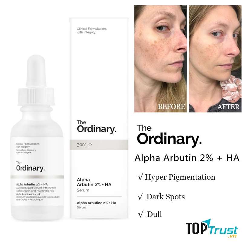 The Ordinary Alpha Arbutin 2% + HA giúp bạn cải thiện làn da của mình.