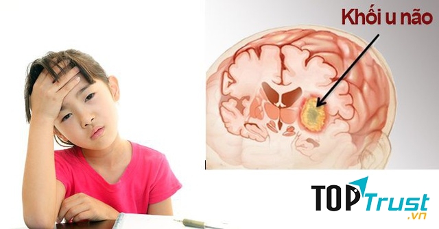 Thiếu ngủ liên quan đến nguy cơ mắc một số bệnh ung thư cao hơn