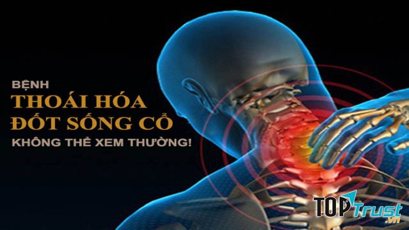 Thoái hóa đốt sống cổ
