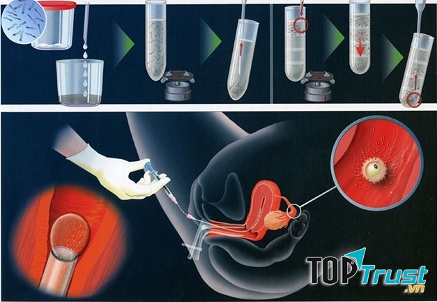 Quá trình thực hiện thụ tinh nhân tạo