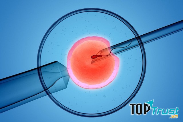 Tiêm tinh trùng vào bào tương trứng (ICSI)
