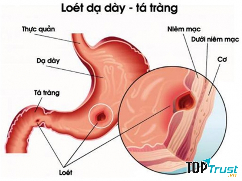 Thủng dạ dày tá tràng